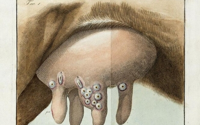 SACCO, Luigi (1769-1836) - Trattato di vaccinazione con