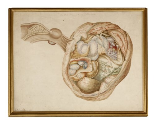 L A COOKE (19th century) A CROSS SECTION OF A MULTI LOCULAR OVARIAN TUMOUR Signed and dated November 1860