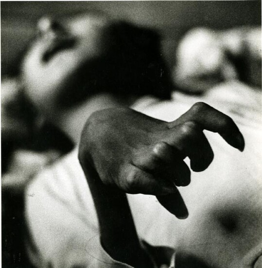 Eugene Smith, "Iwazu Funaba's Crippled Hand. Victim of